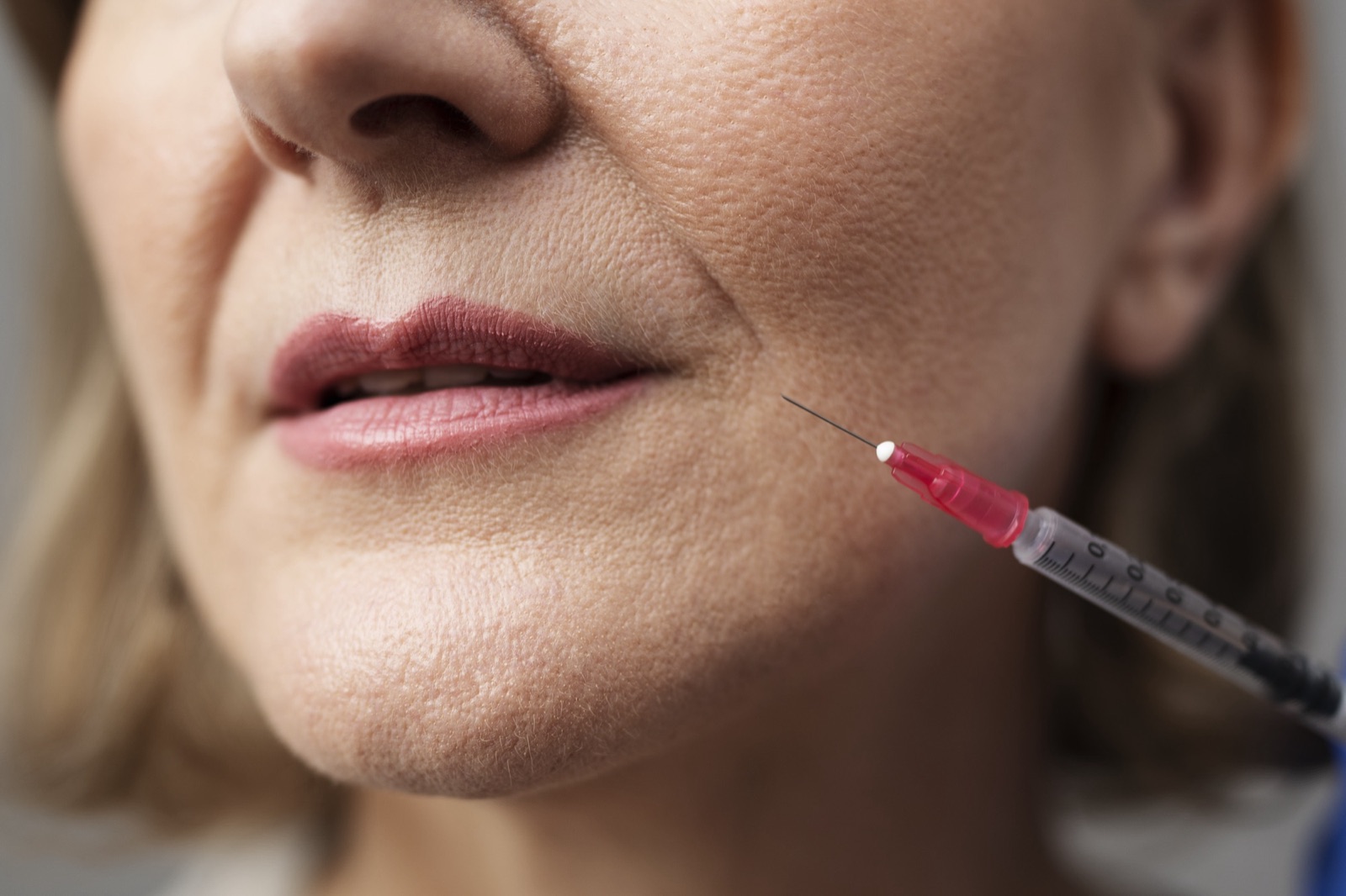 Injection d'acide hyaluronique — Nuevaderm Paris